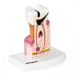Physa ® Model Chorega Zęba Człowieka Z Próchnicą Dla Dentysty W Skali 6:1