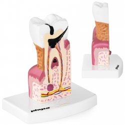 Physa ® Model Chorega Zęba Człowieka Z Próchnicą Dla Dentysty W Skali 6:1