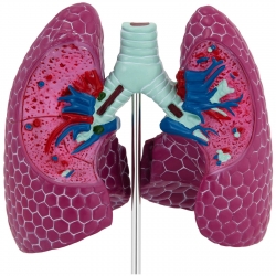 10040329 Physa 4062859971623 Model anatomiczny 3D płuca człowieka ze zmianami chorobowymi